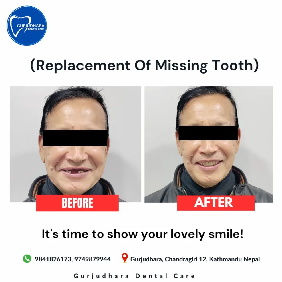 Before and after a missing tooth replaced with a fixed bridge at Gurjudhara Dental Care