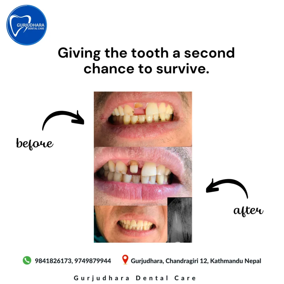 Before and after root canal treatment saving a damaged tooth, Gurjudhara Dental Care